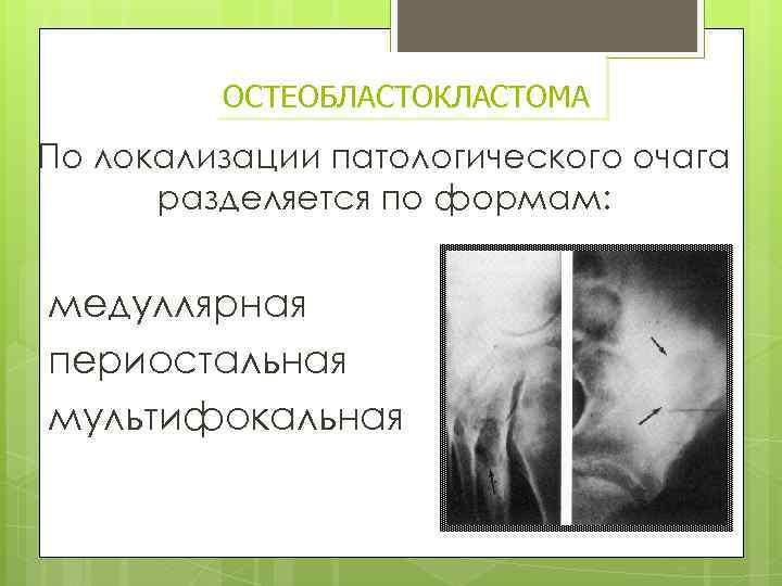 ОСТЕОБЛАСТОКЛАСТОМА По локализации патологического очага разделяется по формам: медуллярная периостальная мультифокальная 