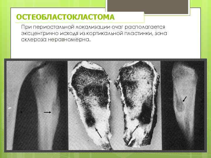ОСТЕОБЛАСТОКЛАСТОМА При периостальной локализации очаг располагается эксцентрично исходя из кортикальной пластинки, зона склероза неравномерна.