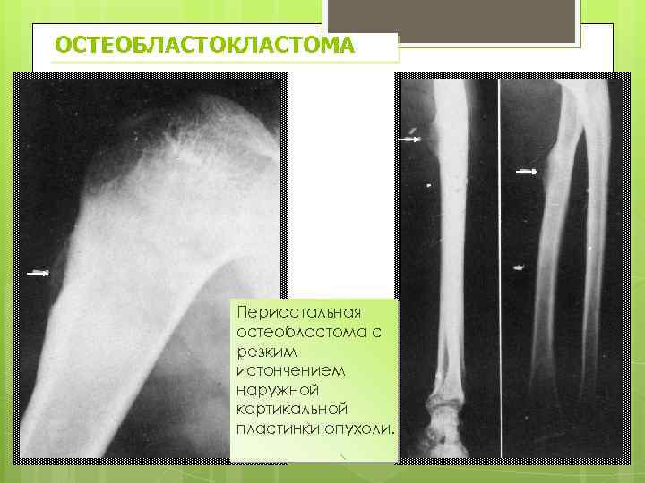 ОСТЕОБЛАСТОКЛАСТОМА Периостальная остеобластома с резким истончением наружной кортикальной пластинки опухоли. 
