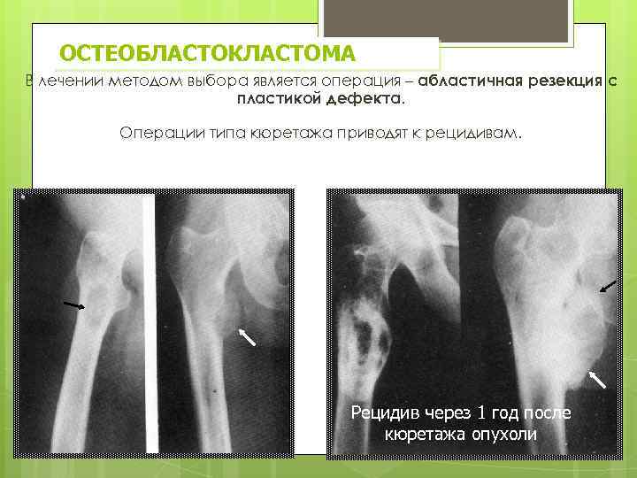 ОСТЕОБЛАСТОКЛАСТОМА В лечении методом выбора является операция – абластичная резекция с пластикой дефекта. Операции