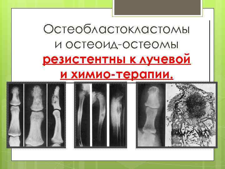 Остеобластокластомы и остеоид-остеомы резистентны к лучевой и химио-терапии. 