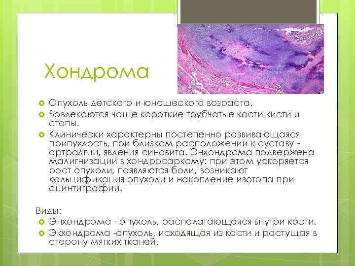 Хондрома Опухоль детского и юношеского возраста. Вовлекаются чаще короткие трубчатые кости кисти и стопы.