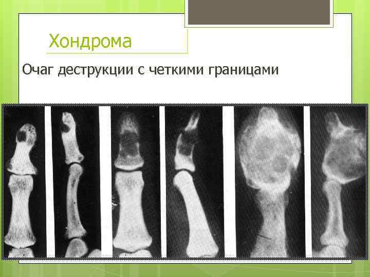 Хондрома Очаг деструкции с четкими границами 