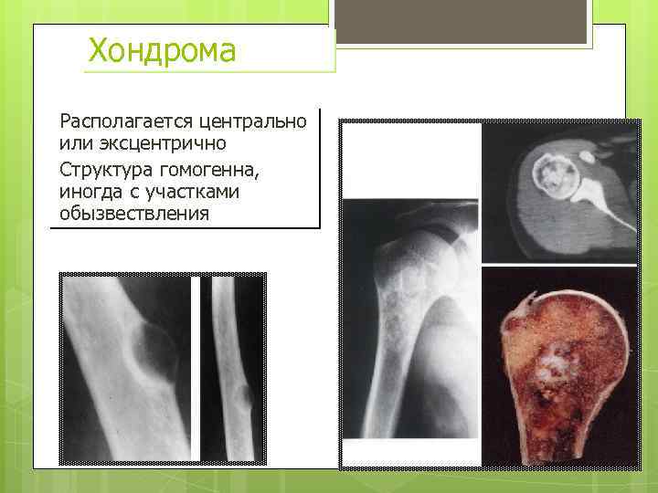 Хондрома Располагается центрально или эксцентрично Структура гомогенна, иногда с участками обызвествления 