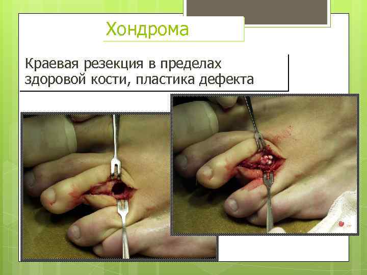 Хондрома Краевая резекция в пределах здоровой кости, пластика дефекта 