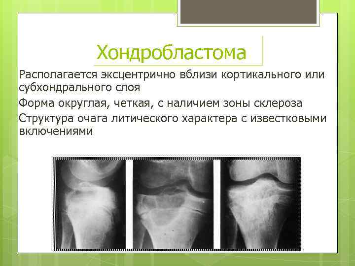 Хондробластома Располагается эксцентрично вблизи кортикального или субхондрального слоя Форма округлая, четкая, с наличием зоны