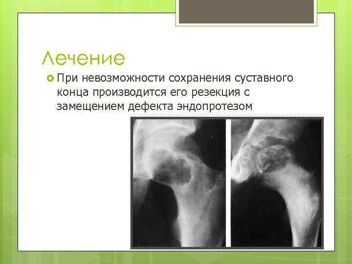Лечение При невозможности сохранения суставного конца производится его резекция с замещением дефекта эндопротезом 