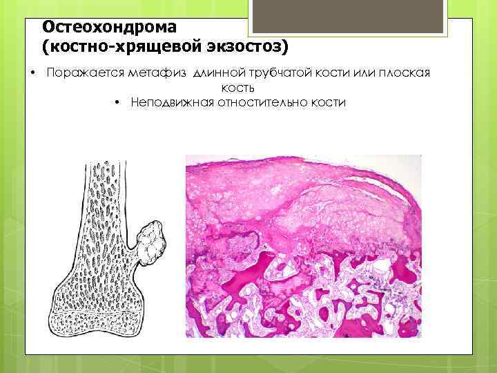 Остеохондрома (костно-хрящевой экзостоз) • Поражается метафиз длинной трубчатой кости или плоская кость • Неподвижная