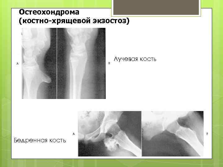 Остеохондрома (костно-хрящевой экзостоз) Лучевая кость Бедренная кость 