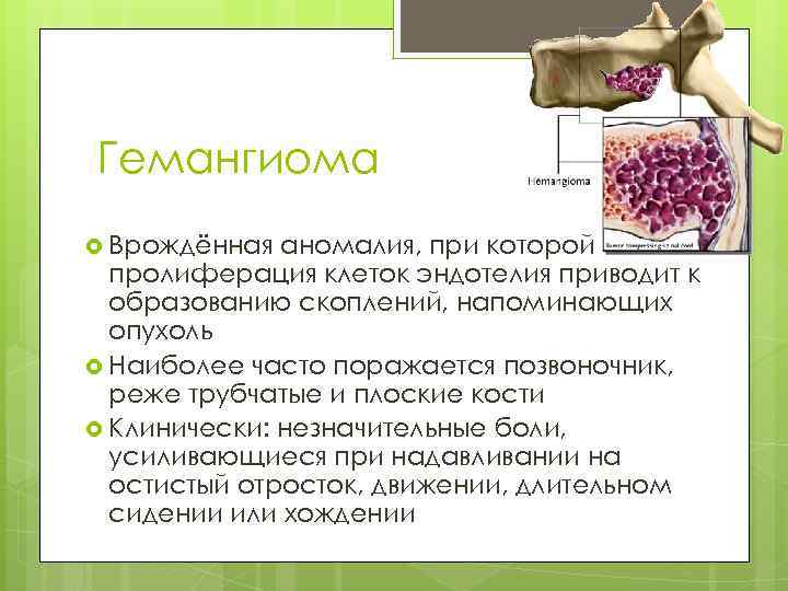 Гемангиома Врождённая аномалия, при которой пролиферация клеток эндотелия приводит к образованию скоплений, напоминающих опухоль