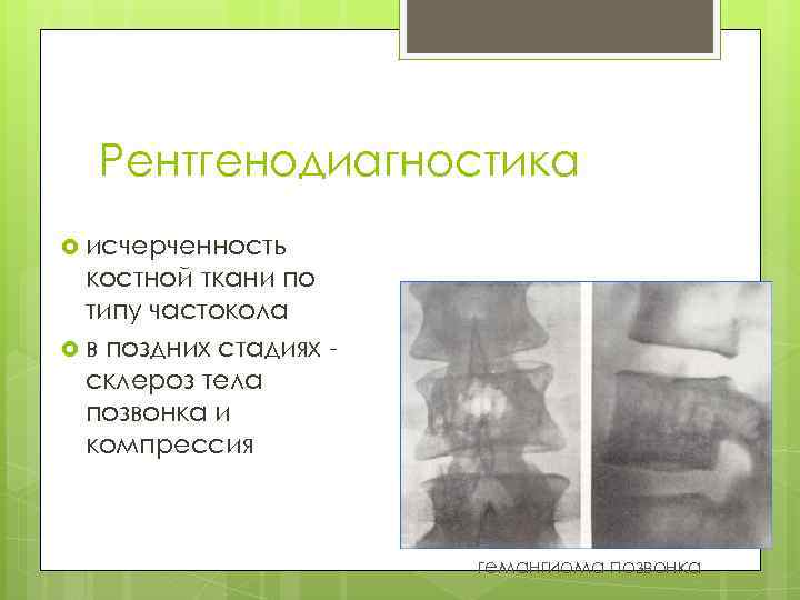 Рентгенодиагностика исчерченность костной ткани по типу частокола в поздних стадиях склероз тела позвонка и