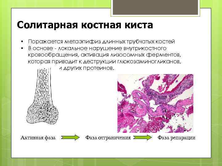 Солитарная костная киста = • Поражается метаэпифиз длинных трубчатых костей • В основе -