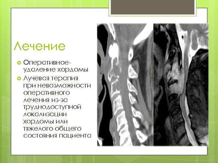 Лечение Оперативноеудаление хордомы Лучевая терапия при невозможности оперативного лечения из-за труднодоступной локализации хордомы или