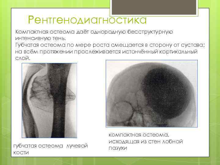 Рентгенодиагностика Компактная остеома даёт однородную бесструктурную интенсивную тень. Губчатая остеома по мере роста смещается