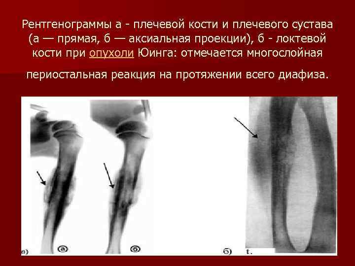 Рентгенограммы а - плечевой кости и плечевого сустава (а — прямая, б — аксиальная