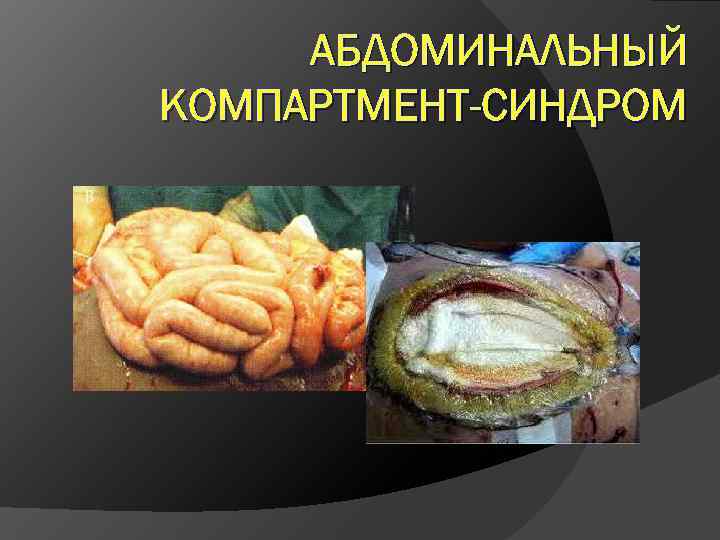 АБДОМИНАЛЬНЫЙ КОМПАРТМЕНТ-СИНДРОМ 