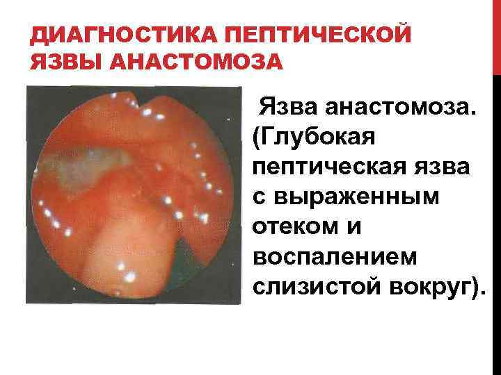 ДИАГНОСТИКА ПЕПТИЧЕСКОЙ ЯЗВЫ АНАСТОМОЗА Язва анастомоза. (Глубокая пептическая язва с выраженным отеком и воспалением