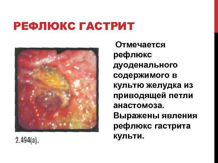 РЕФЛЮКС ГАСТРИТ Отмечается рефлюкс дуоденального содержимого в культю желудка из приводящей петли анастомоза. Выражены