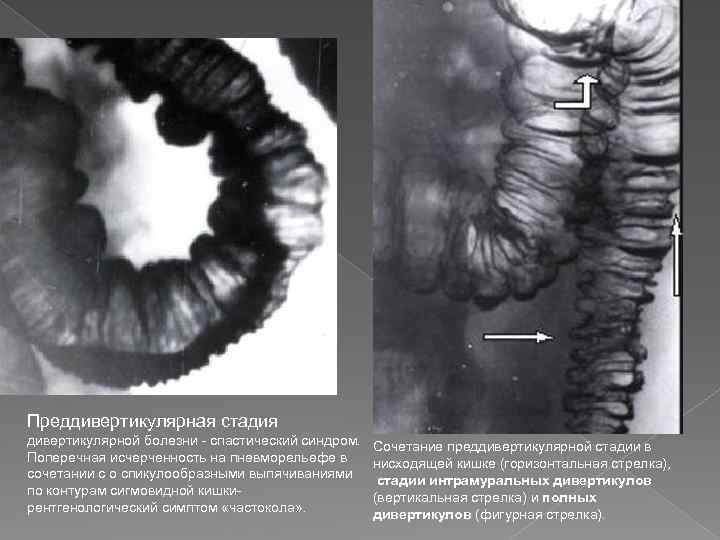 Преддивертикулярная стадия дивертикулярной болезни - спастический синдром. Поперечная исчерченность на пневморельефе в сочетании с