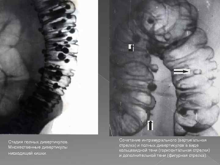Стадия полных дивертикулов. Множественные дивертикулы нисходящей кишки. Сочетание интрамурального (вертикальная стрелка) и полных дивертикулов