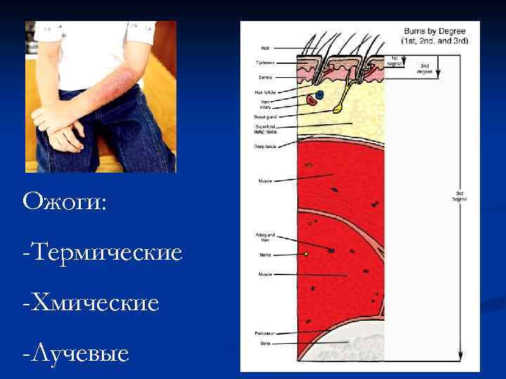 Ожоги: -Термические -Хмические -Лучевые 