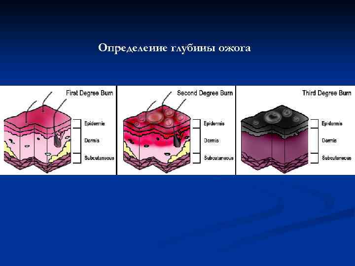 Определение глубины ожога 