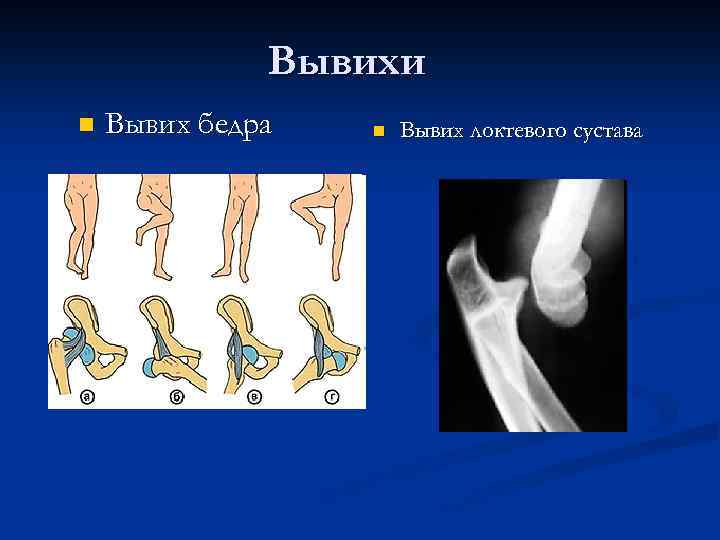 Вывихи n Вывих бедра n Вывих локтевого сустава 