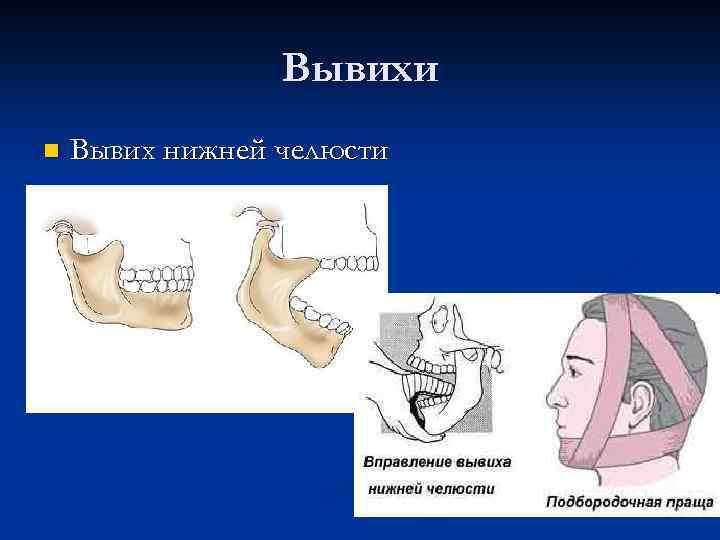 Вывихи n Вывих нижней челюсти 