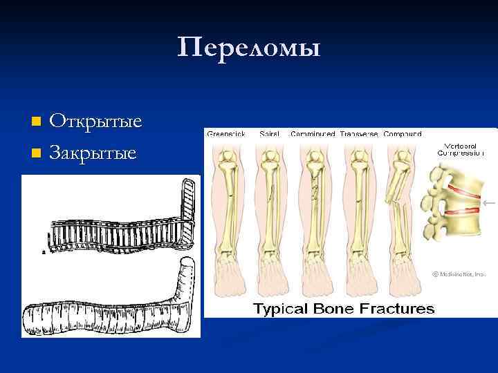 Переломы Открытые n Закрытые n 