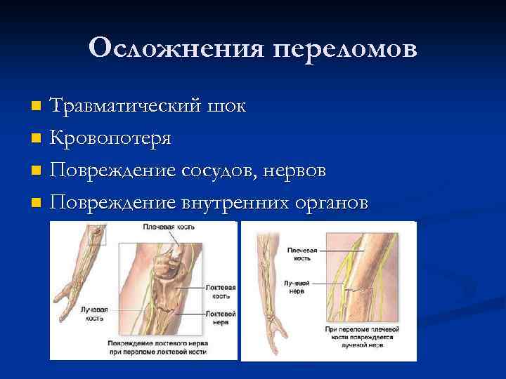 Осложнения переломов Травматический шок n Кровопотеря n Повреждение сосудов, нервов n Повреждение внутренних органов