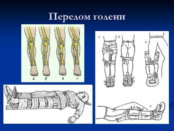 Открытый перелом голени карта смп