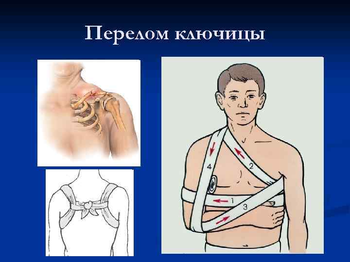 Перелом ключицы презентация