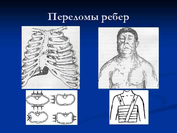 Переломы ребер 