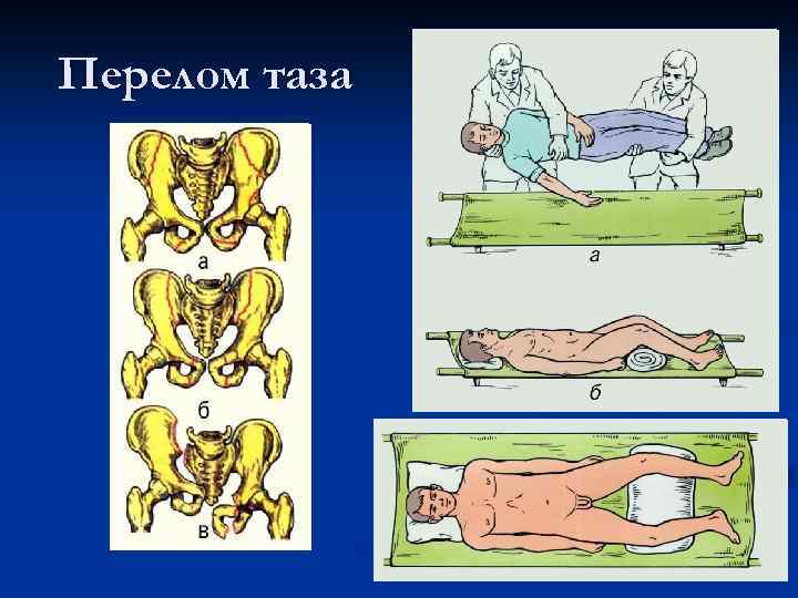 Переломы таза у детей презентация