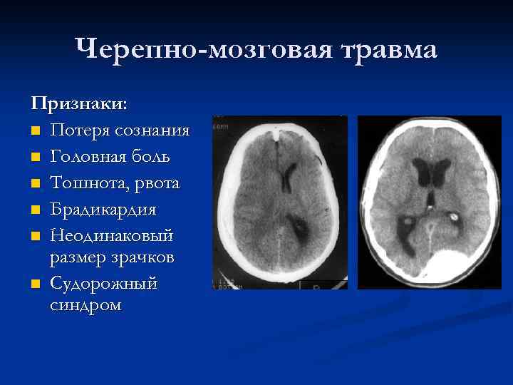 Черепно-мозговая травма Признаки: n Потеря сознания n Головная боль n Тошнота, рвота n Брадикардия