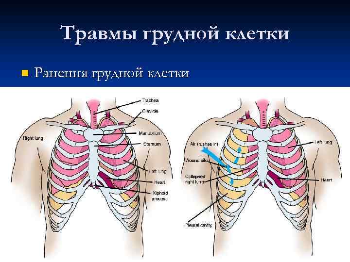 Травмы грудной клетки презентация