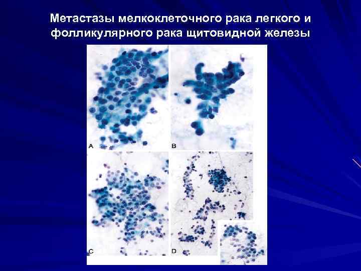 Метастазы мелкоклеточного рака легкого и фолликулярного рака щитовидной железы 