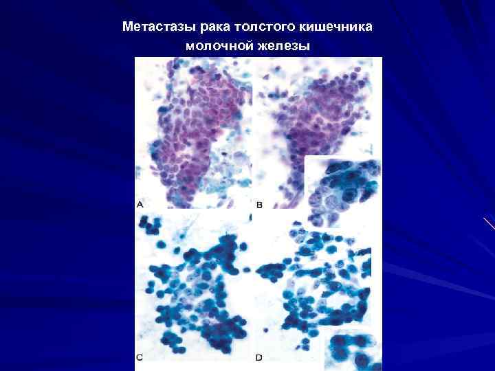 Метастазы рака толстого кишечника молочной железы 