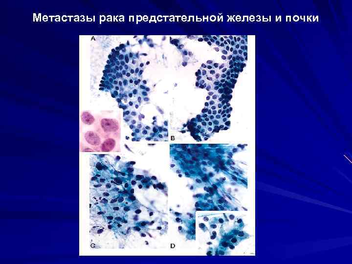 Метастазы рака предстательной железы и почки 