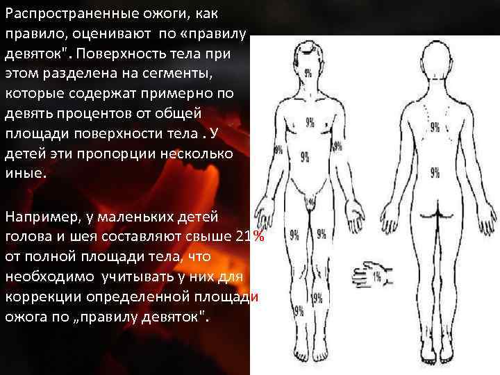 Распространенные ожоги, как правило, оценивают по «правилу девяток