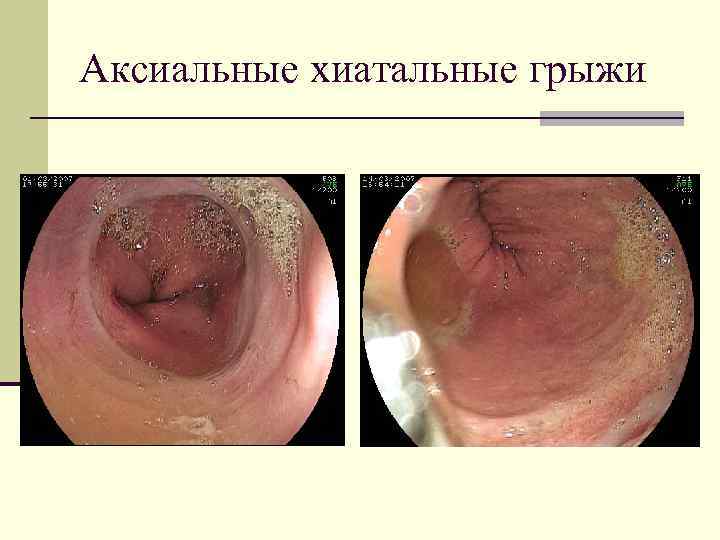 Схема лечения гэрб с эзофагитом