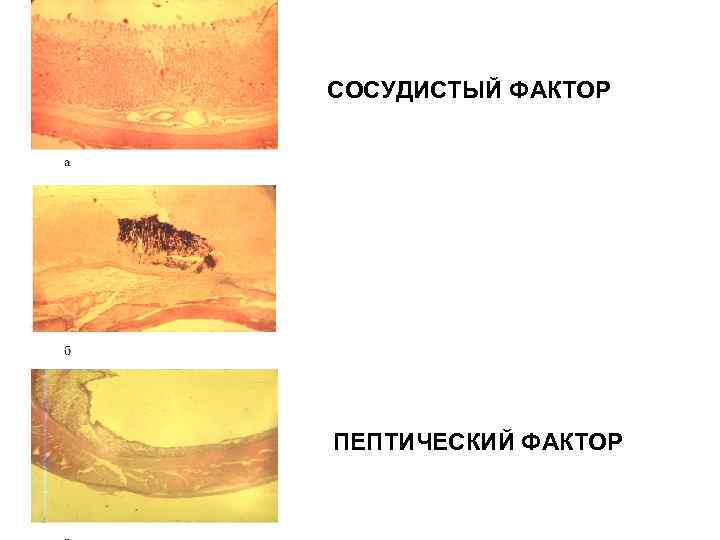 СОСУДИСТЫЙ ФАКТОР ПЕПТИЧЕСКИЙ ФАКТОР 