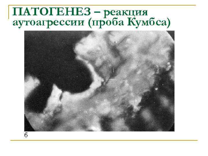 ПАТОГЕНЕЗ – реакция аутоагрессии (проба Кумбса) 