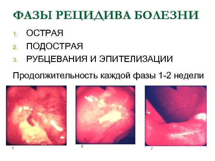 Язвенная болезнь факультетская терапия презентация