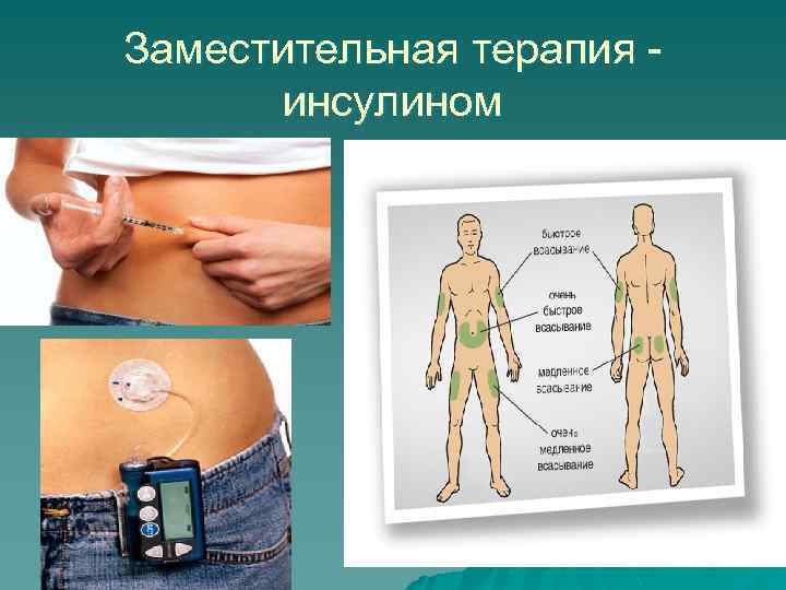 Заместительная терапия инсулином 