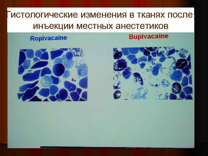 Гистологические изменения в тканях после инъекции местных анестетиков 