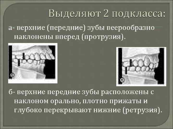 а- верхние (передние) зубы веерообразно наклонены вперед (протрузия). б- верхние передние зубы расположены с