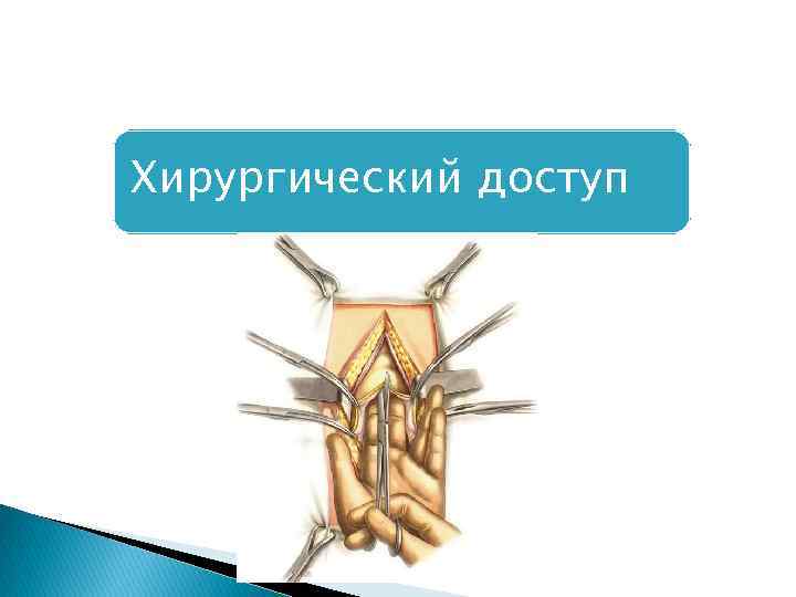 Хирургический доступ 