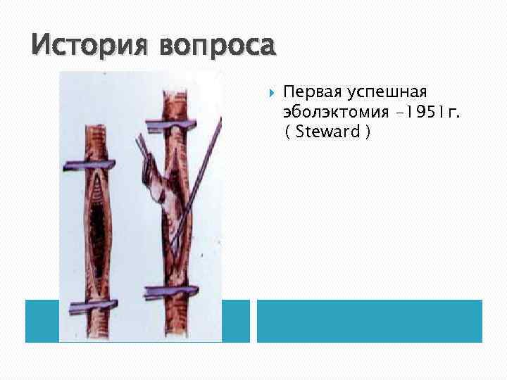 История вопроса Первая успешная эболэктомия -1951 г. ( Steward ) 