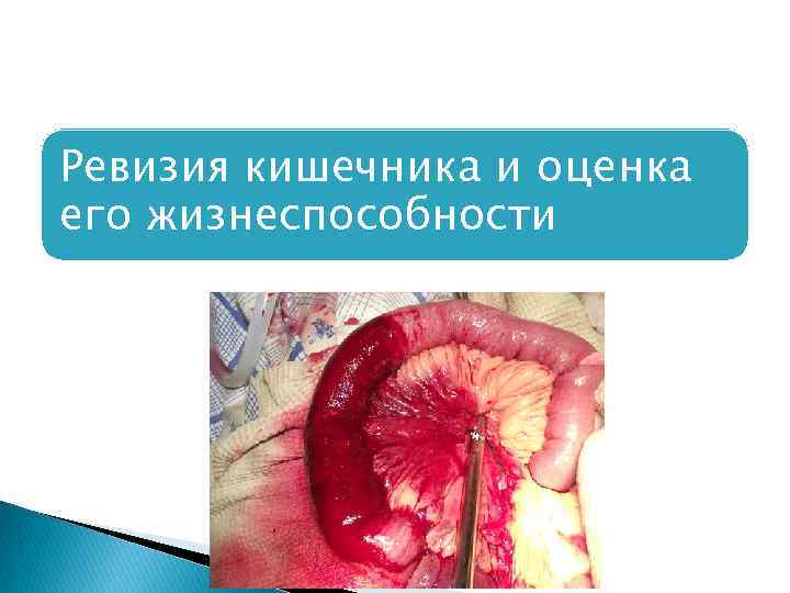 Ревизия кишечника и оценка его жизнеспособности 